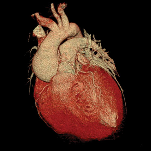 coronary calcium score