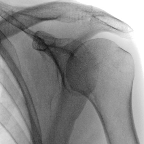 fluoroscopy of shoulder at Imaging Healthcare Specialists in San Diego