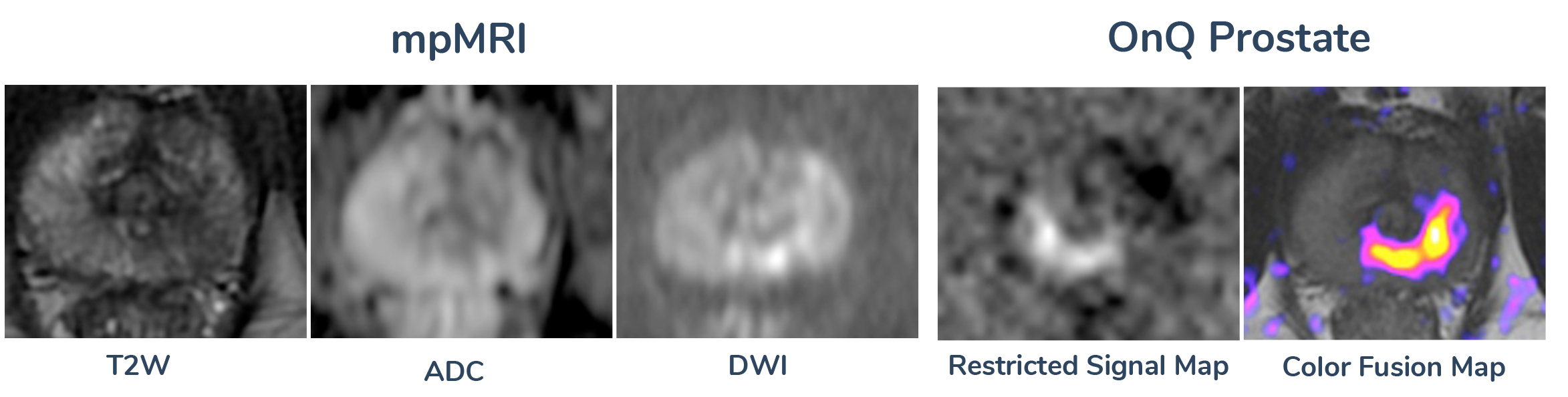 An image comparing mpMRI with OnQ Prostate. mpMRI scans shown are T2W, ADC, and DWI. OnQ Prostate scans shown are restricted signal map and color fusion map.