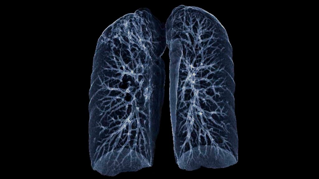 How a 5-Minute Low-Dose Lung Scan Could Save Your Life at Imaging Healthcare Specialists 1