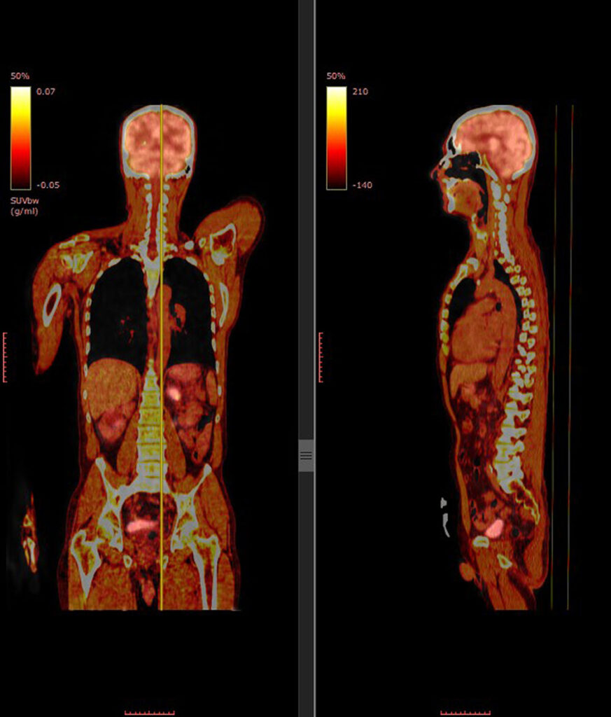 FDG Cancer Imaging 1